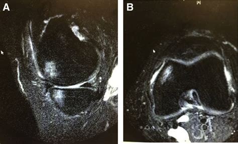 T2 Sagittal A And Axial B Magnetic Resonance Imaging Of A Left Knee