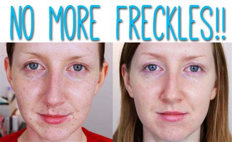 How To Get Rid Of Freckles And Dark Spots On The Face Freckles Removal