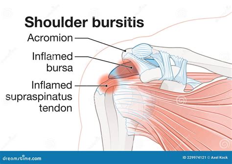 Shoulder Bursitis Inflamed Bursa And Supraspinatus Tendon Stock Image Hot Sex Picture