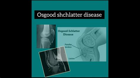 Case Report Osgood Schlatter Diseasemri Knee🦵🦵radiology 20☢️