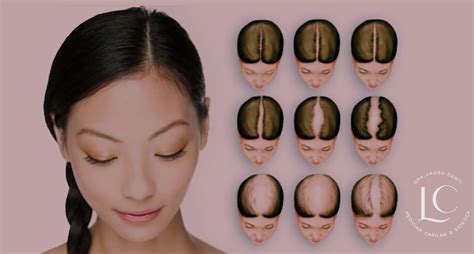Alopecia Androgenética Feminina O Que Você Precisa Saber Sobre A