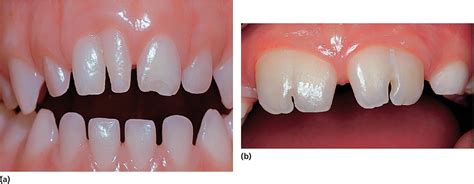 Tooth Development And Disturbances In Number And Shape Of Teeth