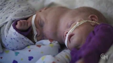 Conjoined Twins Who Survived One Of Worlds Rarest Surgeries Preparing