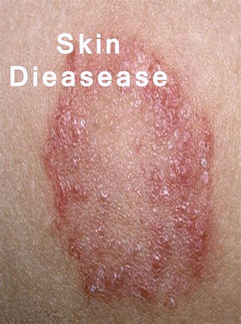 Common Skin Diseases And Conditions Explained