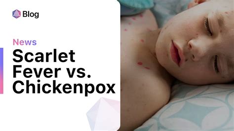 Scarlet Fever Vs Chickenpox How To Tell The Difference Between These