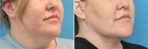 Neck Lift Philadelphia Pa Facial Plastic Surgery Dr Lozada
