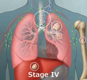 Then they'll put your cancer into one of these two main stages lungcancer.org: Navigating Lung Cancer - Lung Cancer