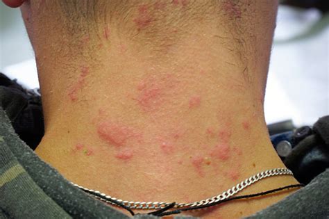 Skin allergies can be caused by many allergens, including sunlight, medications, certain foods, plants jewelry, perfume and other fragrances, and more. Red Skin Rash On The Neck Allergic Reaction On Skin Stock ...