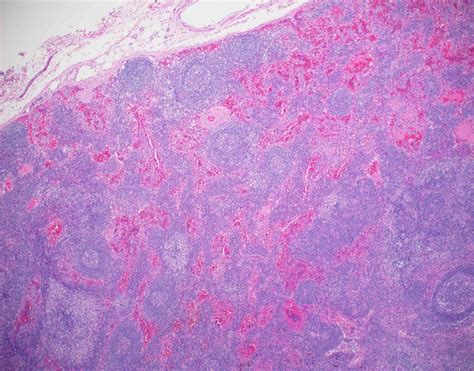 Lymph Node Coloring Home - vrogue.co