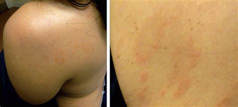 Well Demarcated Scaly Plaques Dermatology Jama Jama Network