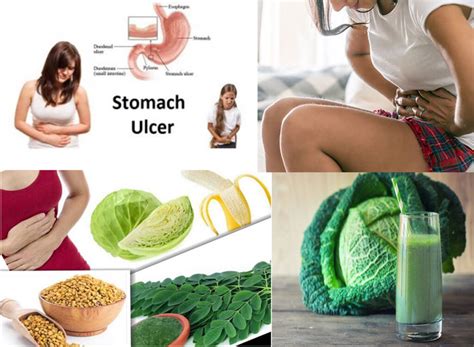 Stomach Ulcers Gastric Ulcer Causes Symptoms Natural Remedies And Prevention