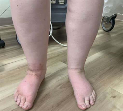 Leg Swelling Treatment In Wilmington Nc Wilmington Leg Swelling