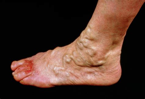 Varicose Veins On The Foot With Ulceration Of Toes Photograph By