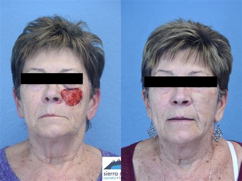 Facial Reconstruction Surgery Reno Facial Reconstruction Surgeon Near Me