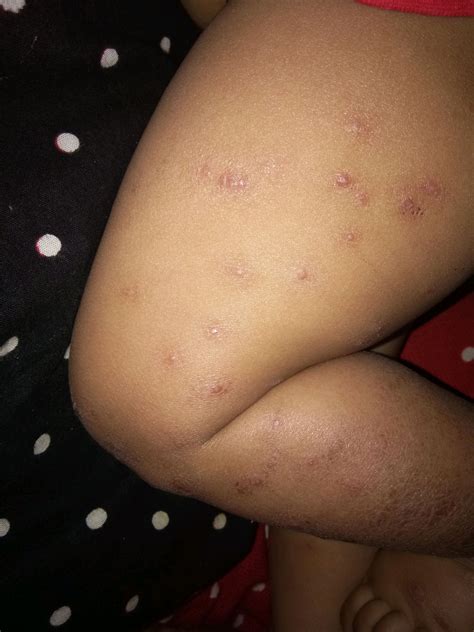 Black Rashes Since 6 Months Only On Head Leg N Arms I Consulted Skin