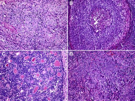 Human Papillomavirus In Tonsillar Squamous Cell Carcinomas From