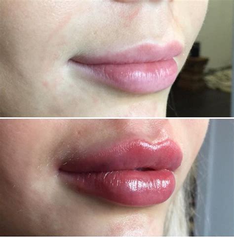 Qandas For Lip Fillerslip Injections Dr Ricky Best Cosmetic Clinic