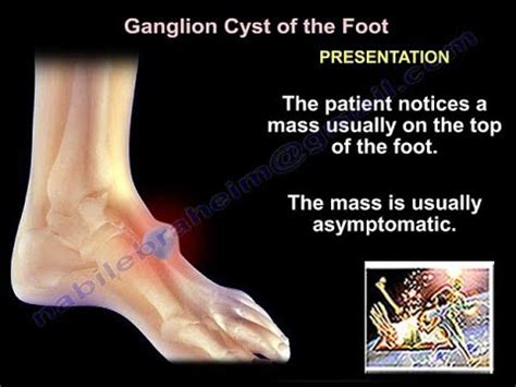 Foot And Ankle Ganglion Cyst Everything You Need To Know Dr Nabil Ebraheim Youtube