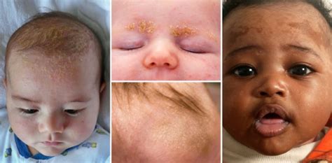 Cradle Cap Seborrheic Dermatitis In Babies Causes And Treatments