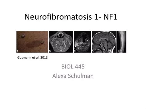 Ppt Neurofibromatosis 1 Nf1 Powerpoint Presentation Free Download
