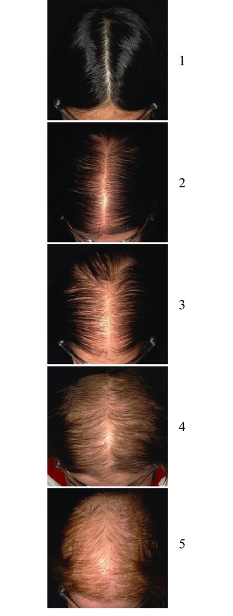 Sinclair Hair Loss Severity Scale For Female Pattern Hair Loss