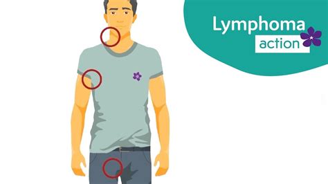 The Symptoms Of Lymphoma Youtube
