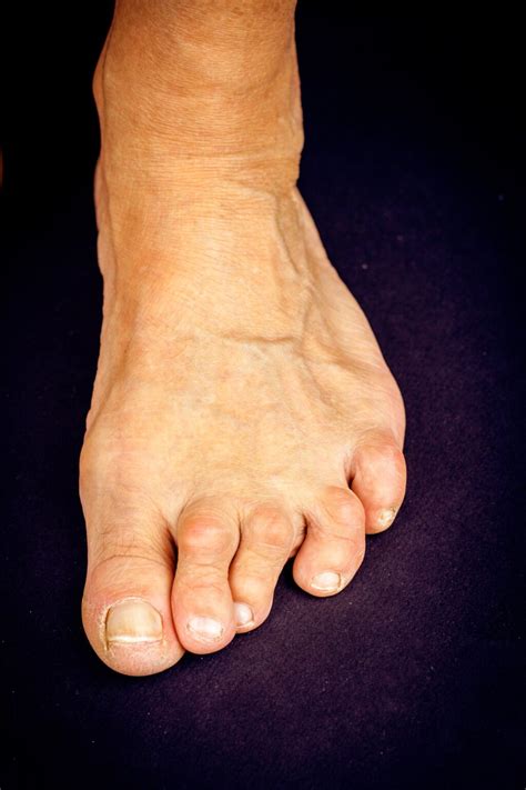 How To Treat Overlapping Toes Dr Lance Silverman