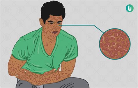 Smallpox Symptoms Causes Treatment Prevention Diagnosis Medicine
