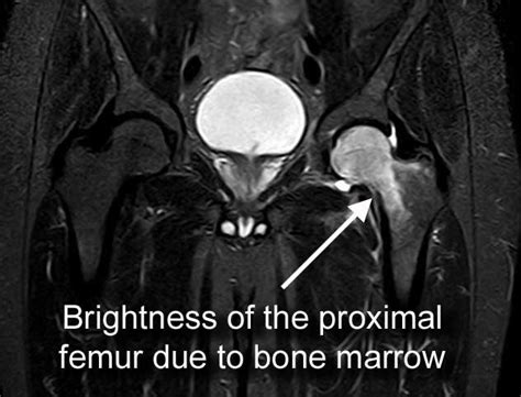 Transient Hip Osteoporosis Hip And Knee Clinic