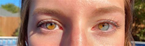 I Have Partial Heterochromia In Both Eyes Mildlyinteresting