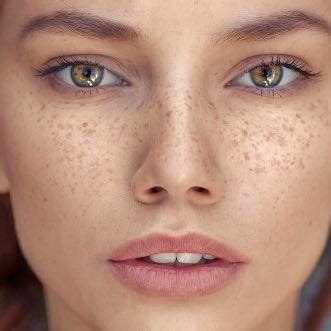 Sommersprossen — sommersprossen , die an stirn , nase , im übrigen gesicht , an den armen bei personen mit seiner , weißer oder krankhaft bleicher haut im sommer vorkommen und oft im winter. Gibt es ein Make-up, dass Rötungen abdeckt aber ...