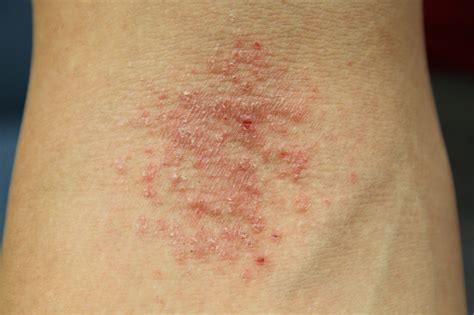 Eczema Bumps On Arms