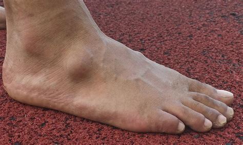 That Bump On Your Foot Could Be A Ganglion Cyst Says Zephyrhills