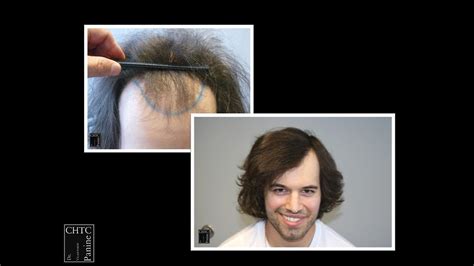 Hair Transplant Patient Before And After Photos With Panine Md And