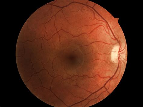 Digital Retinal Imaging F L Wangler Opticians