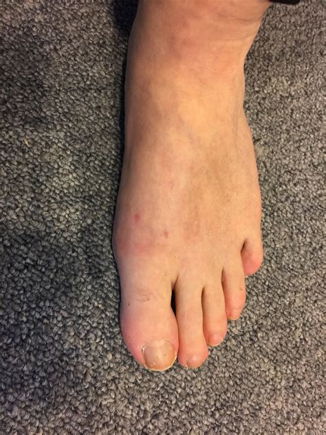 Minimally Invasive Hallux Rigidus Osteotomy David Redfern Surgery