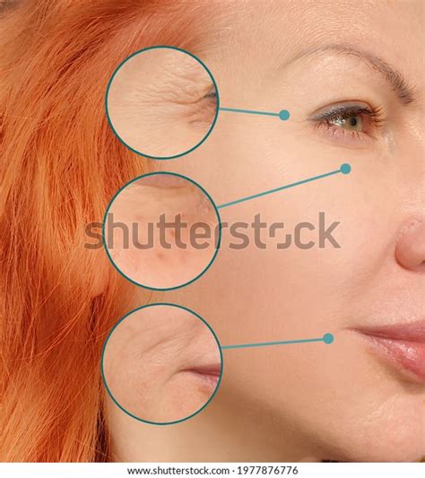 Woman Face Wrinkles Before After Treatment Stock Photo Edit Now
