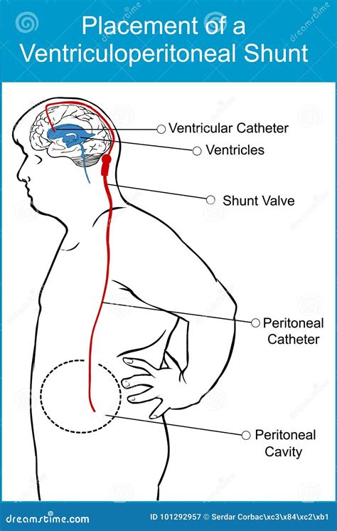 Placement Of A Ventriculoperitoneal Shunt Stock Vector Illustration