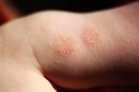 Nummular Eczema Symptoms Causes Treatment