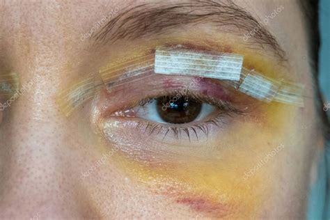 Cerrar Los Ojos De La Mujer Después De La Cirugía Plástica Hematomas