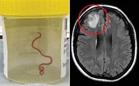 Doctors Remove 3 Inch Parasitic Worm From Woman’s Brain In World First