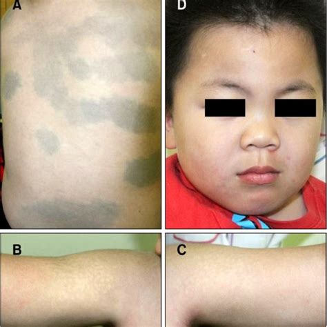 Pdf Hunter Syndrome With Extensive Mongolian Spots