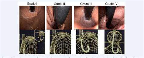 Figure 1 From Hiatus Hernia In Nigerians An Endoscopic Study