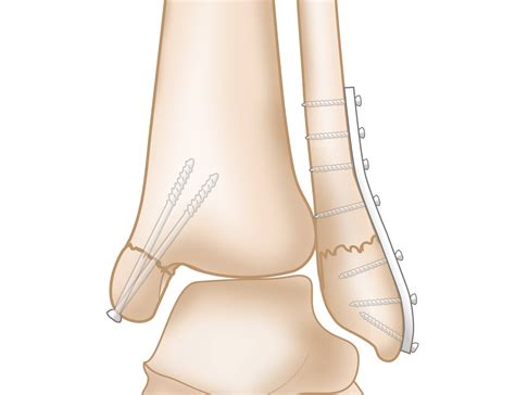 Ankle Fractures Broken Ankle OrthoInfo AAOS