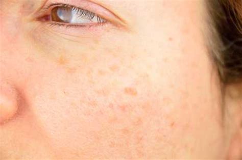 Sunspots On Skin Causes Natural Remedies And Prevention Tips