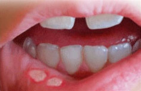 Research Dispels Myths About Recurrent Aphthous Stomatitis Dentistry