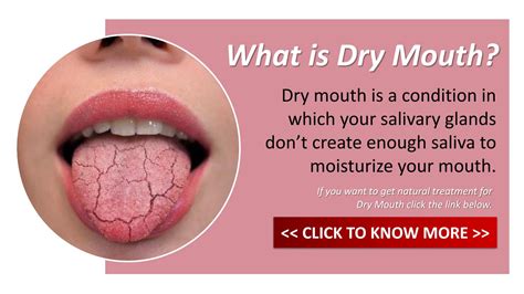 Dry Mouth Treatment by Christopher-Browning - Issuu