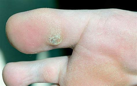 Warts Burbank Podiatrist Los Angeles Foot And Ankle Center