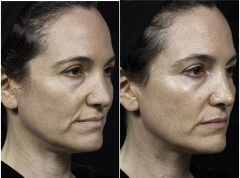 Thermage Before And After Photos Patient 30 Houston Tx Dermsurgery Associates