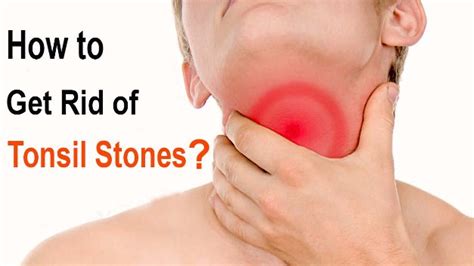 How To Get Rid Of Tonsil Stones